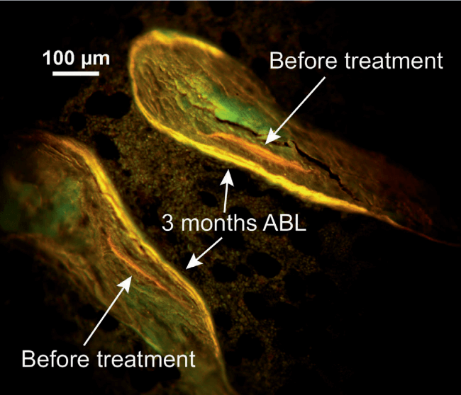 Illustration of increased mineralizing surface in cancellous bone with abaloparatide treatment