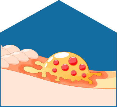 Illustration representing modest bone resorption