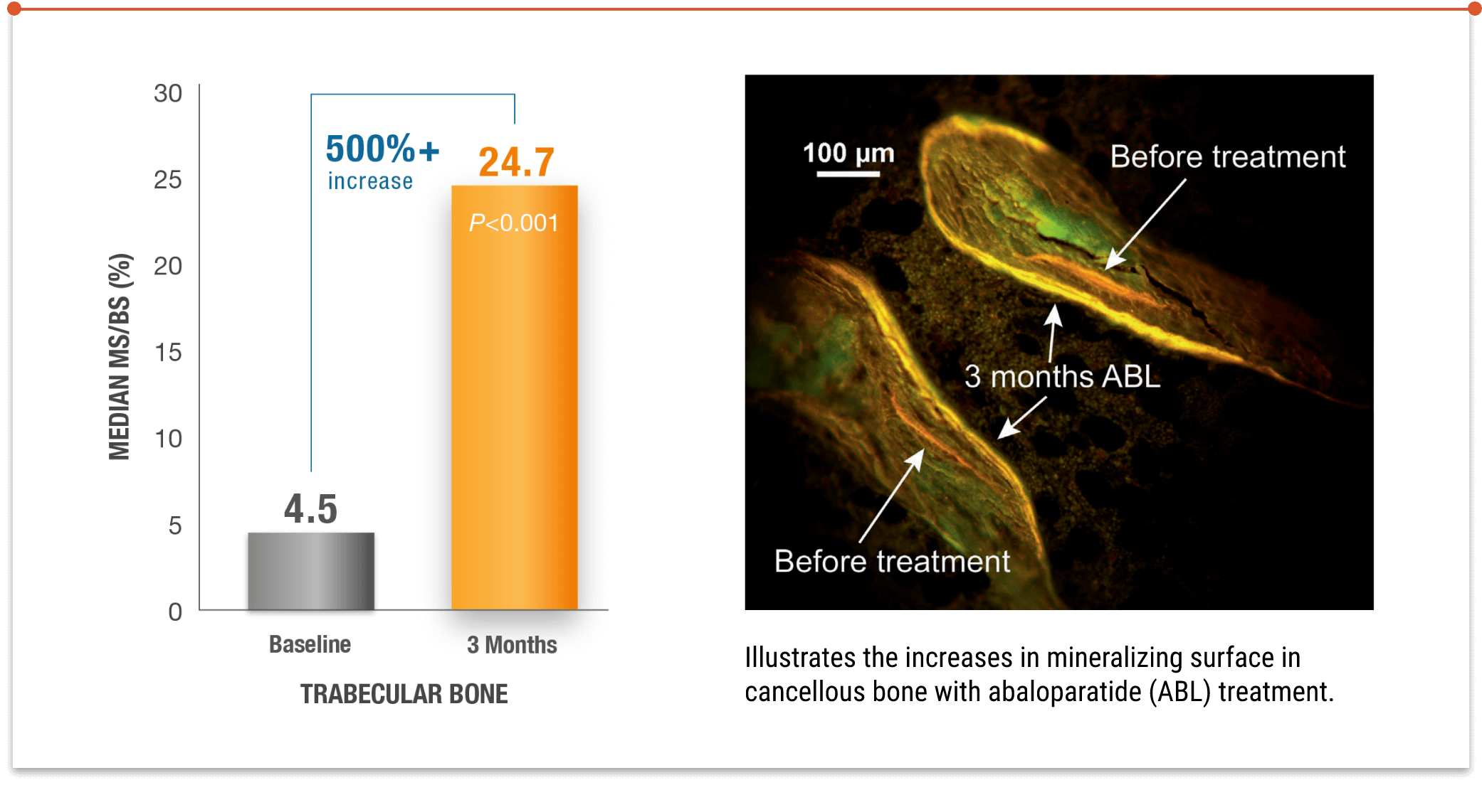 Bar graph showing median mineralizing surface (MS/BS) in trabecular bone increasing from 4.5% at baseline to 24.7% after 3 months of abaloparatide treatment (over 500% increase, P